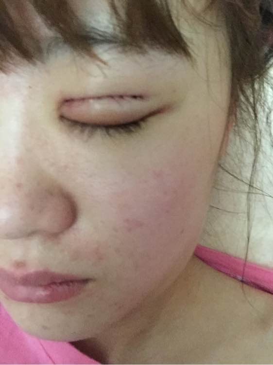 全切双眼皮一个月还是肿怎么回事,全切双眼皮一个月还肿是怎么回事
