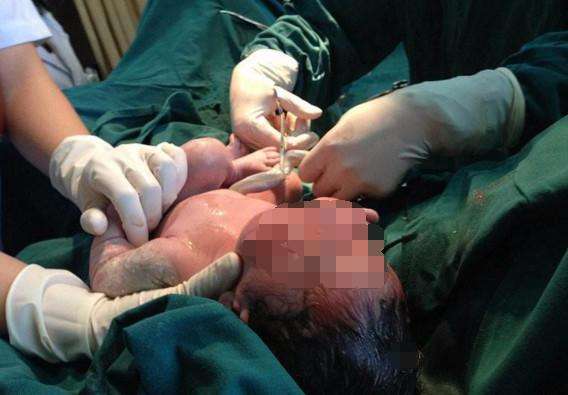 一层层，一刀刀切开孕妇肚子，剖腹产并不是你想象的那么简单