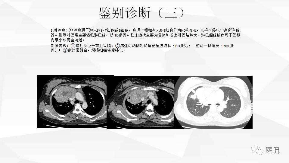 精原细胞瘤ct影像,精原细胞瘤影像特征