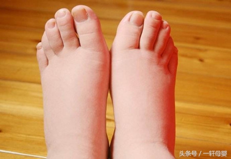 孕晚期出现水肿孕妈该如何缓解,孕晚期水肿是因为没运动引起的吗