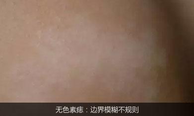 不是白癜风的白斑能查出是什么吗,不是白癜风的白点是啥