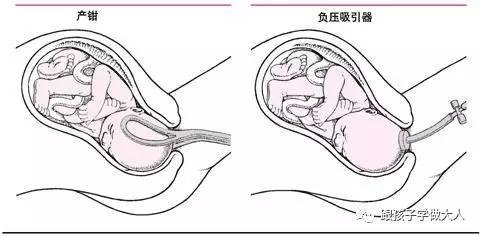 顺产时遇到的那些事,顺产也觉得心疼
