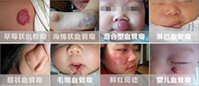 颅内海绵状血管瘤手术费用是多少,血管瘤的治疗方法及费用