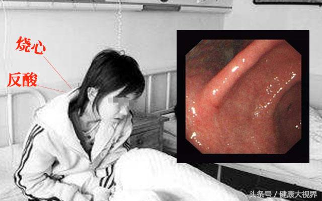 反流性食管胃炎该怎样治疗？生死折磨！一剂“妙药”让他重获新生