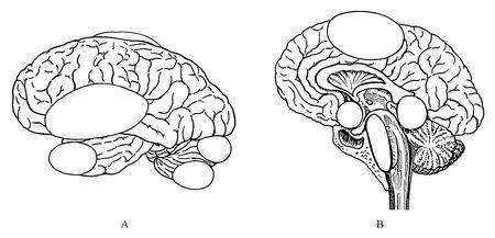 颅内出血会导致蛛网膜囊肿吗,蛛网膜囊肿导致硬膜下出血