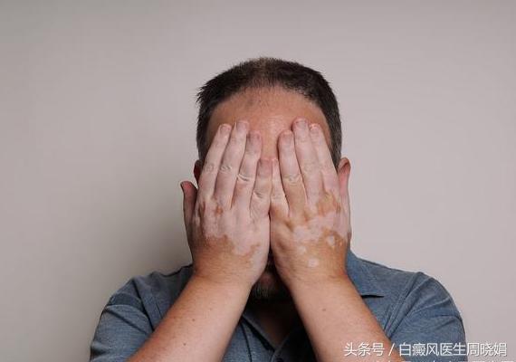 白癜风能自愈吗试试这5种方法,白癜风患者如何开导