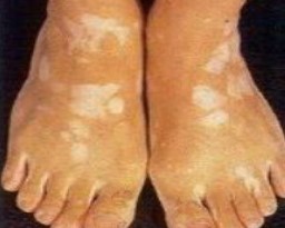 白癜风治疗要多久?还有哪些要注意?