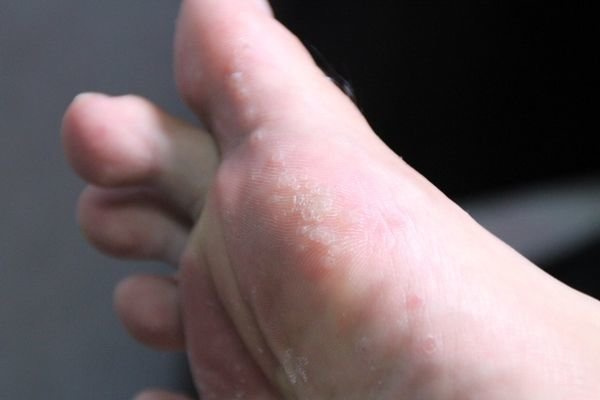 脚气无法治断根,脚气不止痒