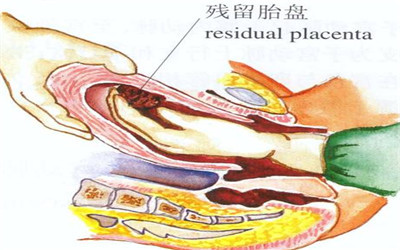 刻骨铭心的经历永生难忘,手动剥胎盘的经历