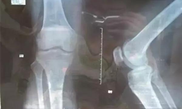 预防孩子患上佝偻病要注意什么,佝偻病是常见病吗