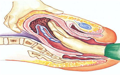 刻骨铭心的经历永生难忘,手动剥胎盘的经历