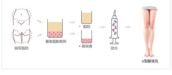王明利自体脂肪填充好不好,王明利自体脂肪丰臀怎么样