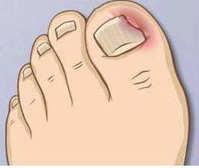 脚趾甲往里面长如何让它恢复正常,脚趾甲往肉里长怎么办视频
