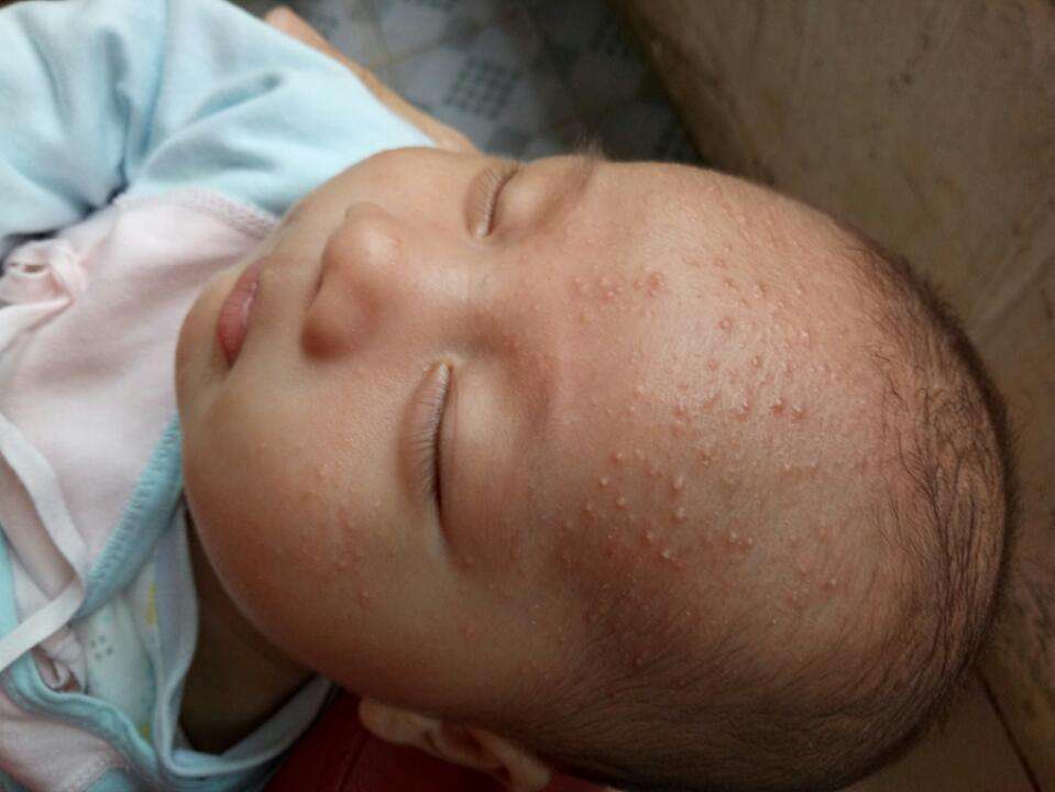 9个月宝宝发烧后出疹子怎么处理,九个月宝宝出疹子发烧怎么处理