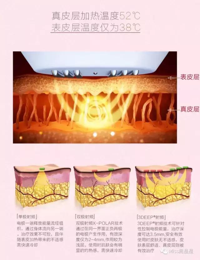 射频美容仪中的LV和香奈儿，Stop和NEWA选哪个？