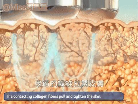 射频美容仪中的LV和香奈儿，Stop和NEWA选哪个？