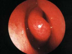 过敏性鼻炎皮下免疫治疗专家共识,皮下埋植治疗过敏性鼻炎