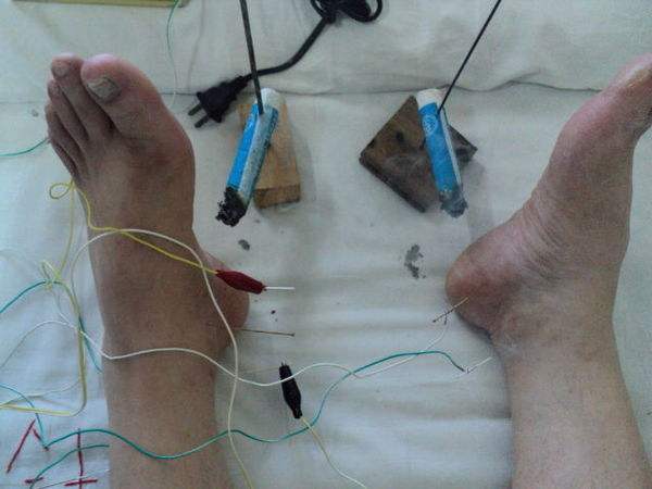 足跟钻心痛是什么原因,足跟痛反复发作怎么办