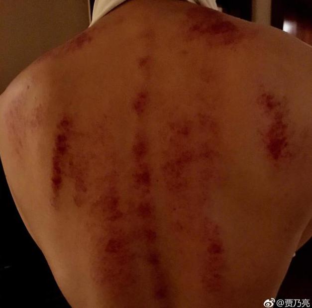 刮痧真的能去火吗？一男星录节目病倒刮痧去火引争议