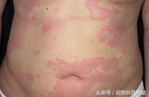 皮肤科医生怎么看诊,30秒带你了解皮肤病