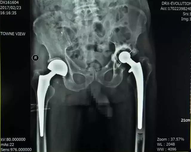 人生最后一次骨折保守治疗,髋部骨折又称人生最后一次骨折