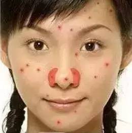 为什么长闭口粉刺痘痘还总是反复,痘痘反复长你知道是为什么吗