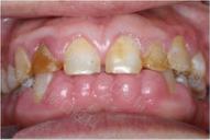 牙龈不增生的降压药,降压药引起的牙龈增生会好吗