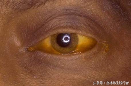 中国有多少人患乙肝,乙肝大三阳发展成肝硬化肝癌概率