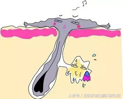 滚蛋吧！白斑病症（白癜风）