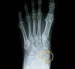 踝关节疼痛病因病机,踝关节伤病