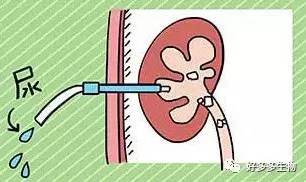 肾积水——尿都堵了，肾怎么能好
