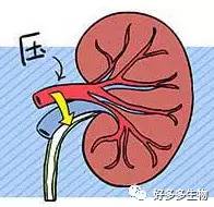 肾积水引发的尿漏怎么办,肾积水排尿困难吃什么药