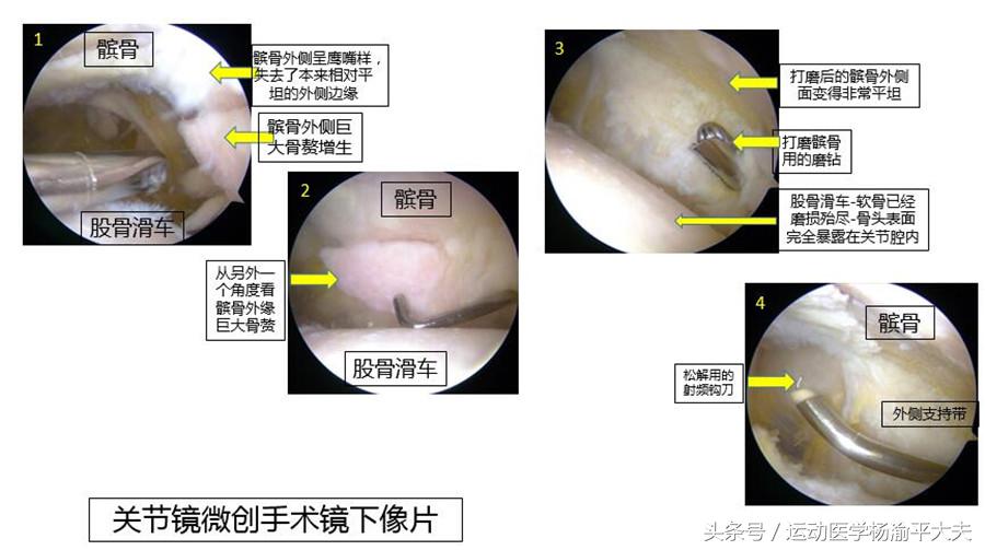 上下楼膝关节疼痛最好治疗方法,膝关节疼痛怎样上下楼能缓解疼痛