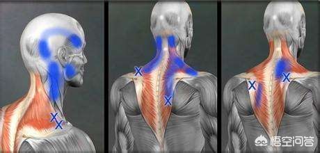颈椎病患者如何选用枕头,神经型颈椎病枕高枕头还是低枕头