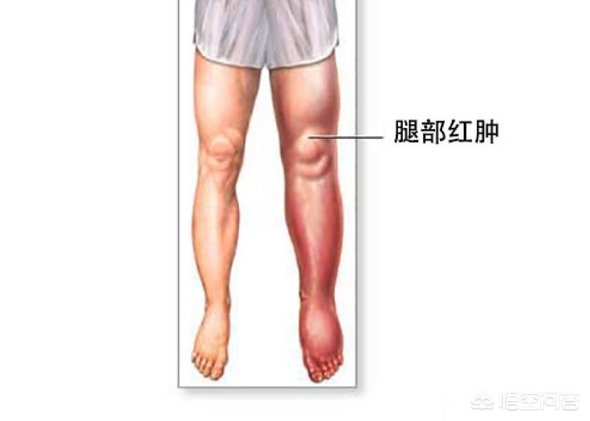 骨折术后下肢血栓好治吗,骨折术后怎样预防下肢静脉血栓