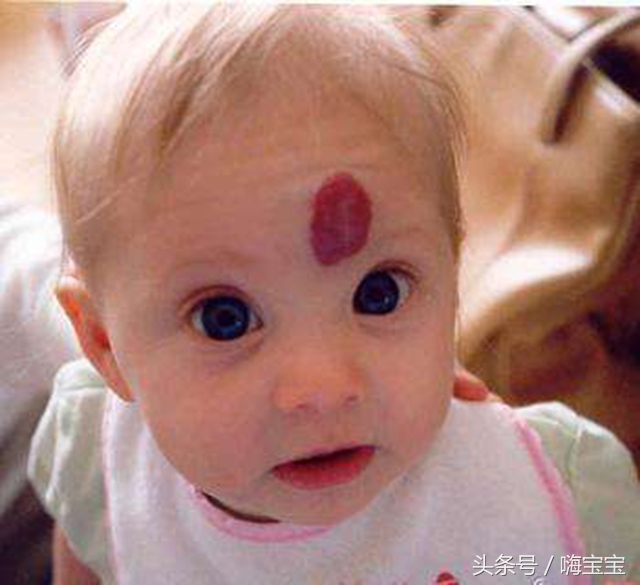 小孩皮肤胎记多,孩子身上各种颜色胎记
