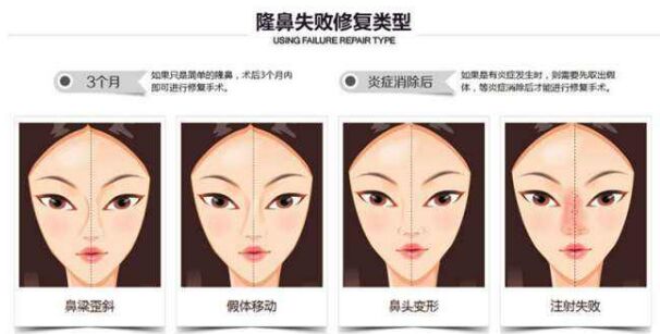 做了隆鼻手术怎么都不消肿,做隆鼻手术失败有哪些症状