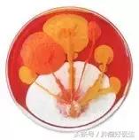 原位癌与转移癌的区别,病理如何判断原位癌和浸润性癌