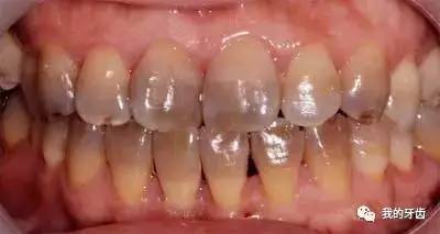 冷光美白牙齿靠谱吗,牙齿美白全过程视频