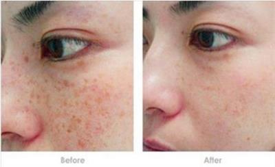 激光治疗祛雀斑,激光祛雀斑的最佳方法