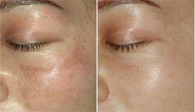 激光祛斑前你需要了解这些才能更好祛斑