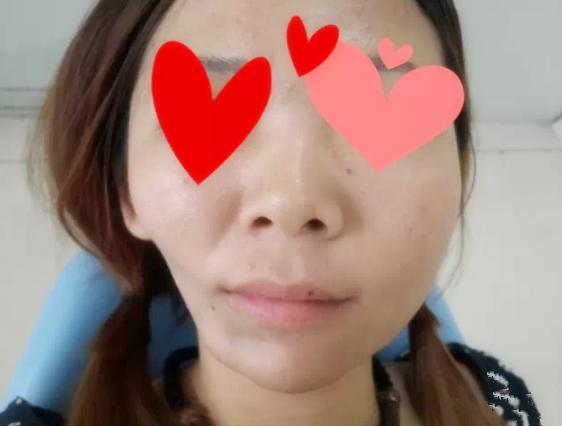 用一边牙齿吃饭脸歪了能恢复吗,长期一边吃饭脸歪