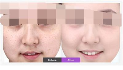东莞激光祛雀斑效果如何,雀斑激光点阵有效果吗
