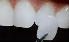 牙齿黄又丑又尴尬,牙齿黄笑的难看怎么办