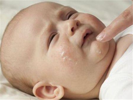 宝宝湿疹不要愁,快看皮肤科医生怎样治疗自家宝宝的湿疹?