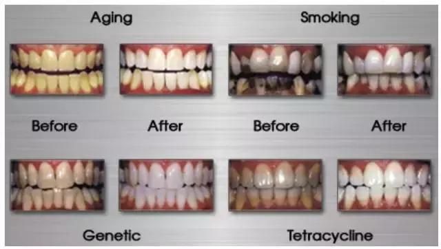 牙齿黄又丑又尴尬,牙齿黄笑的难看怎么办