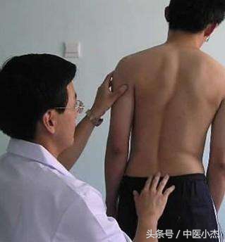 高考体检有强直性脊柱炎,孩子高考腰疼如何治疗