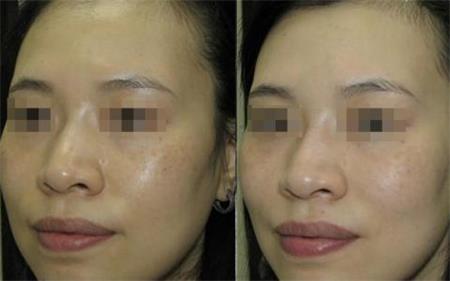 敏感肌肤能用激光吗,敏感肌肤能做激光祛斑吗