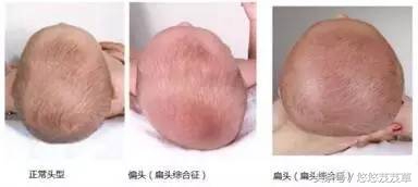 如何纠正宝宝平头头型,宝宝平头怎么调整
