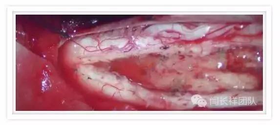 闫长祥脑膜瘤,闫长祥能治愈弥漫中线胶质瘤吗